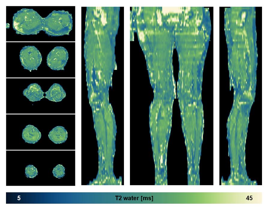 The water only T2 relaxation time of the lower extremity obtained from multi echo spin echo t2 mapping with EPG based reconstruction.